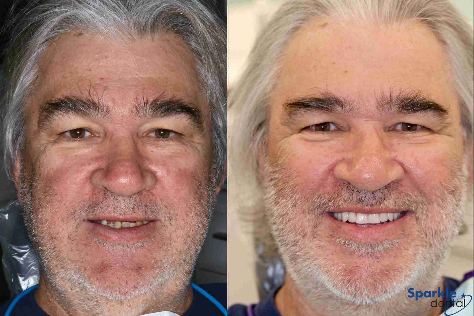 Implants Blog Benefits of Dental implants