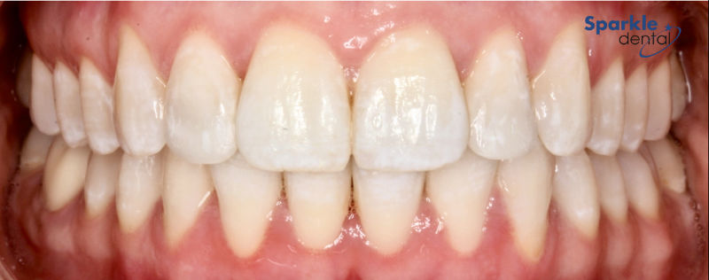 Perfect smile after cosmetic dentistry invisalign treatment