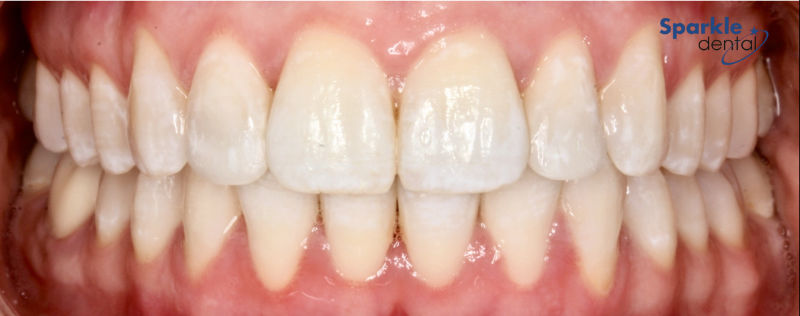 Cosmetic After Perfect smile after cosmetic dentistry invisalign treatment