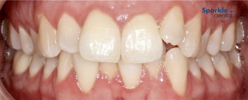 Cosmetic Before Before Invisalign is the clear solution