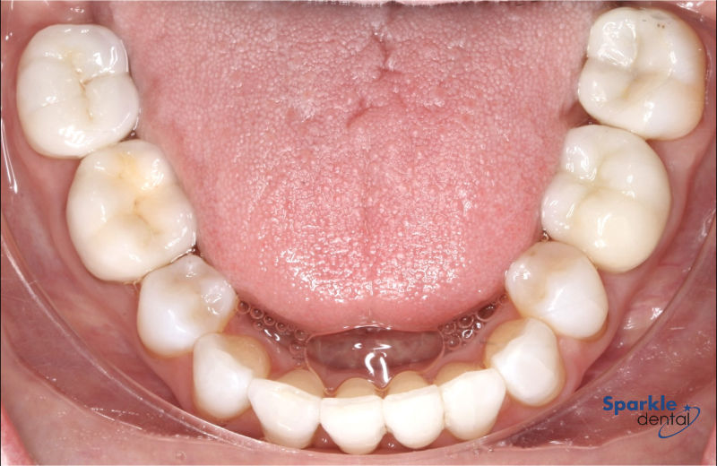 Invisalign After Invisalign After