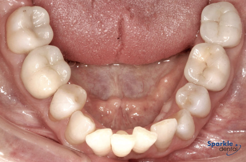 Invisalign Before