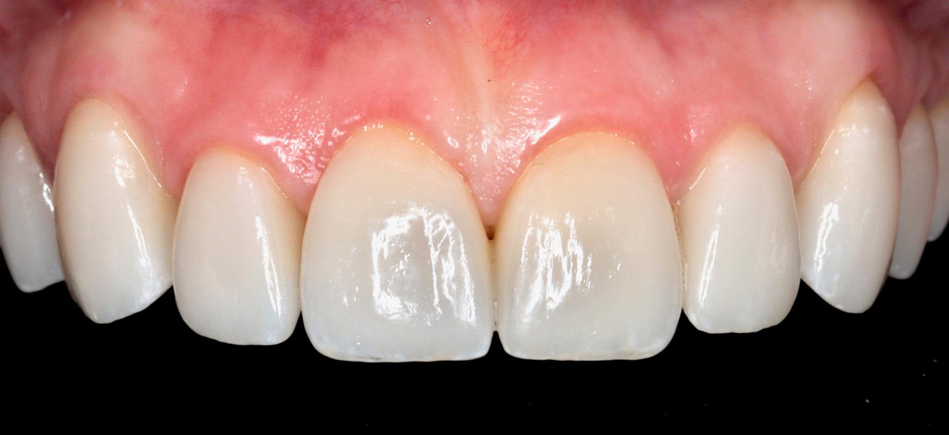41043641 3d11 4590 Bba9 5e59b94d6ee6 Smile Makeover with Sparkle Dental