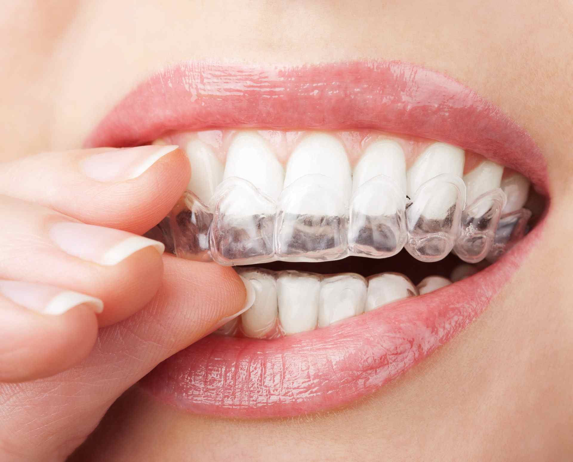 Invisalign leading tooth straightening system