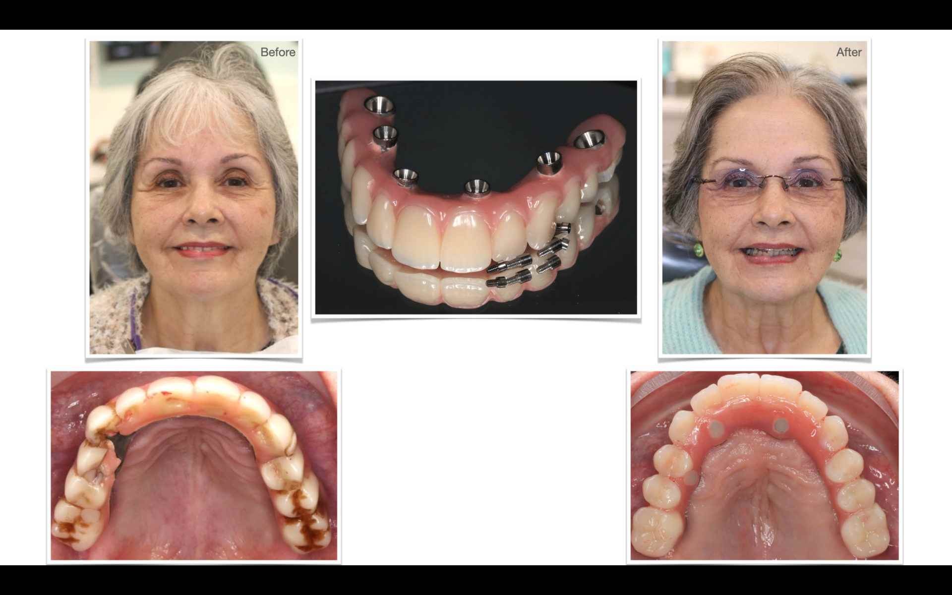 Before & after All-on-X full teeth replacement treatment