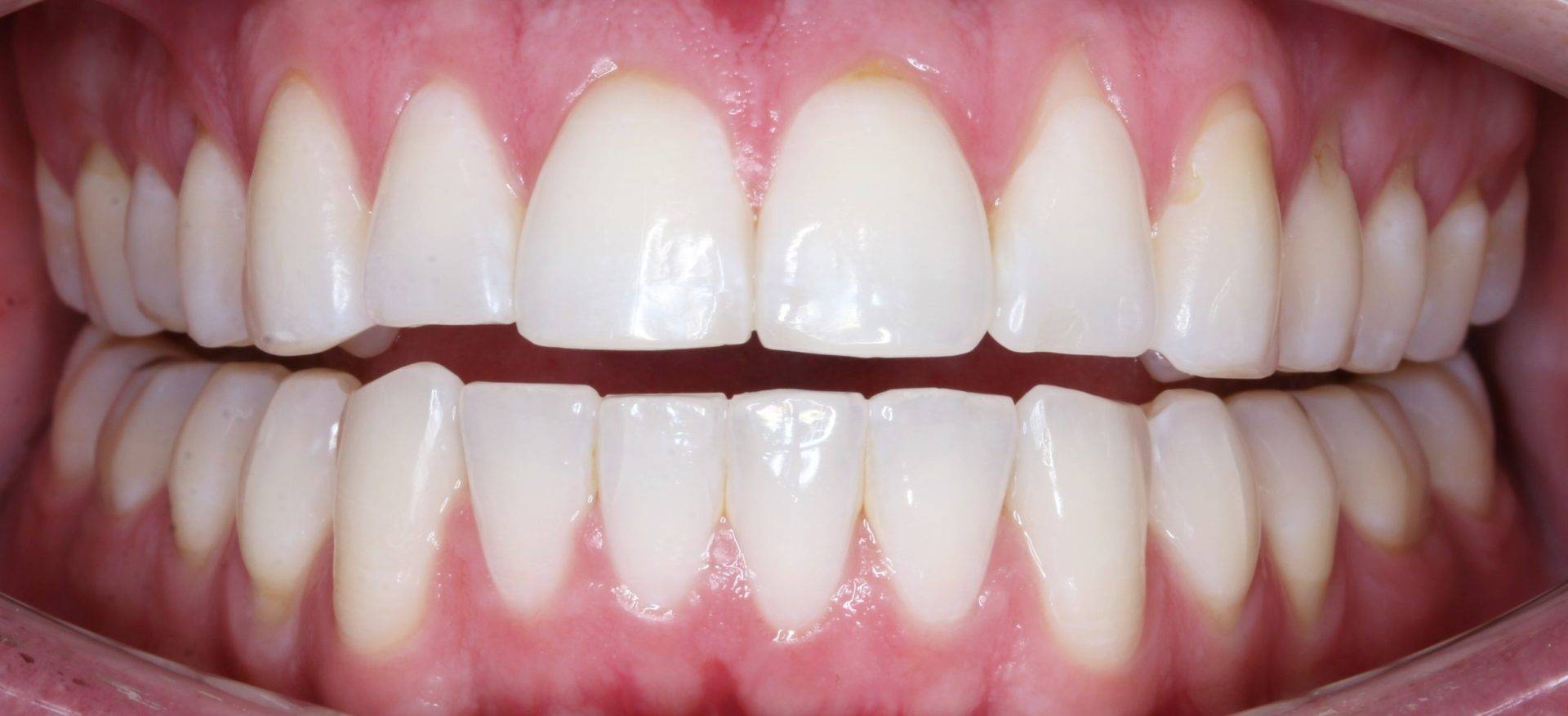 Invisalign After Invisalign After