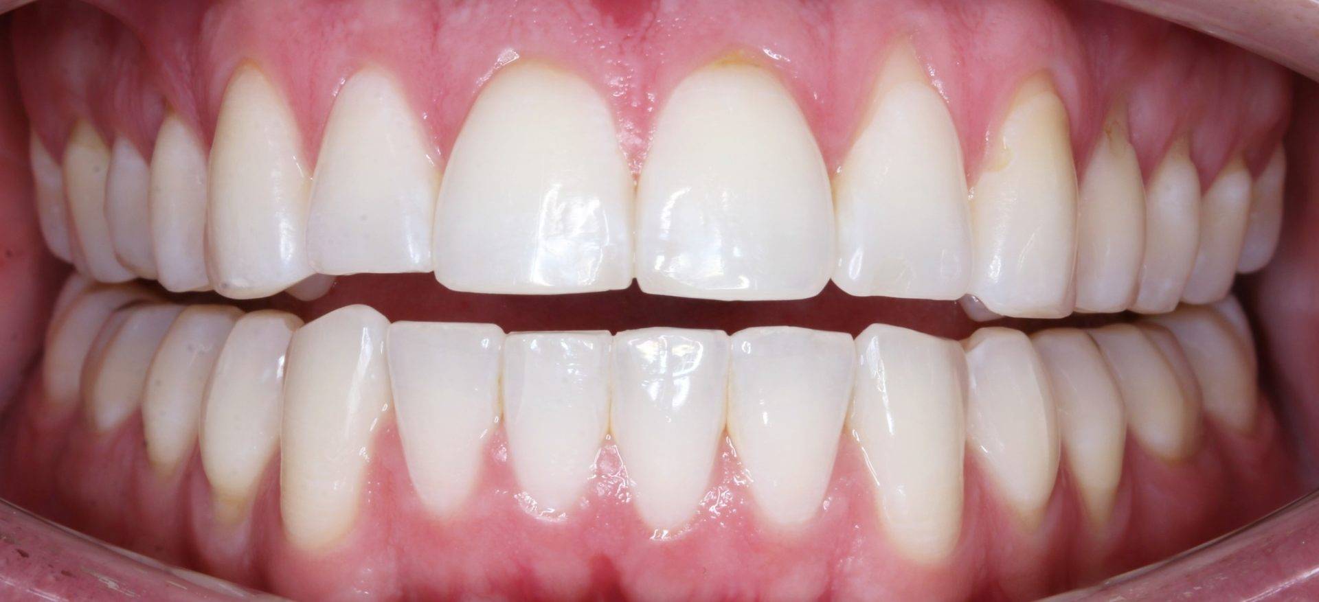 Invisalign After