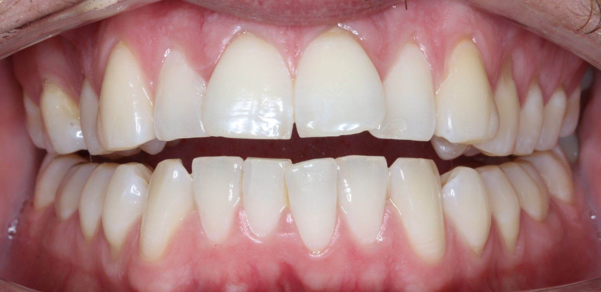 Invisalign Before Invisalign Before