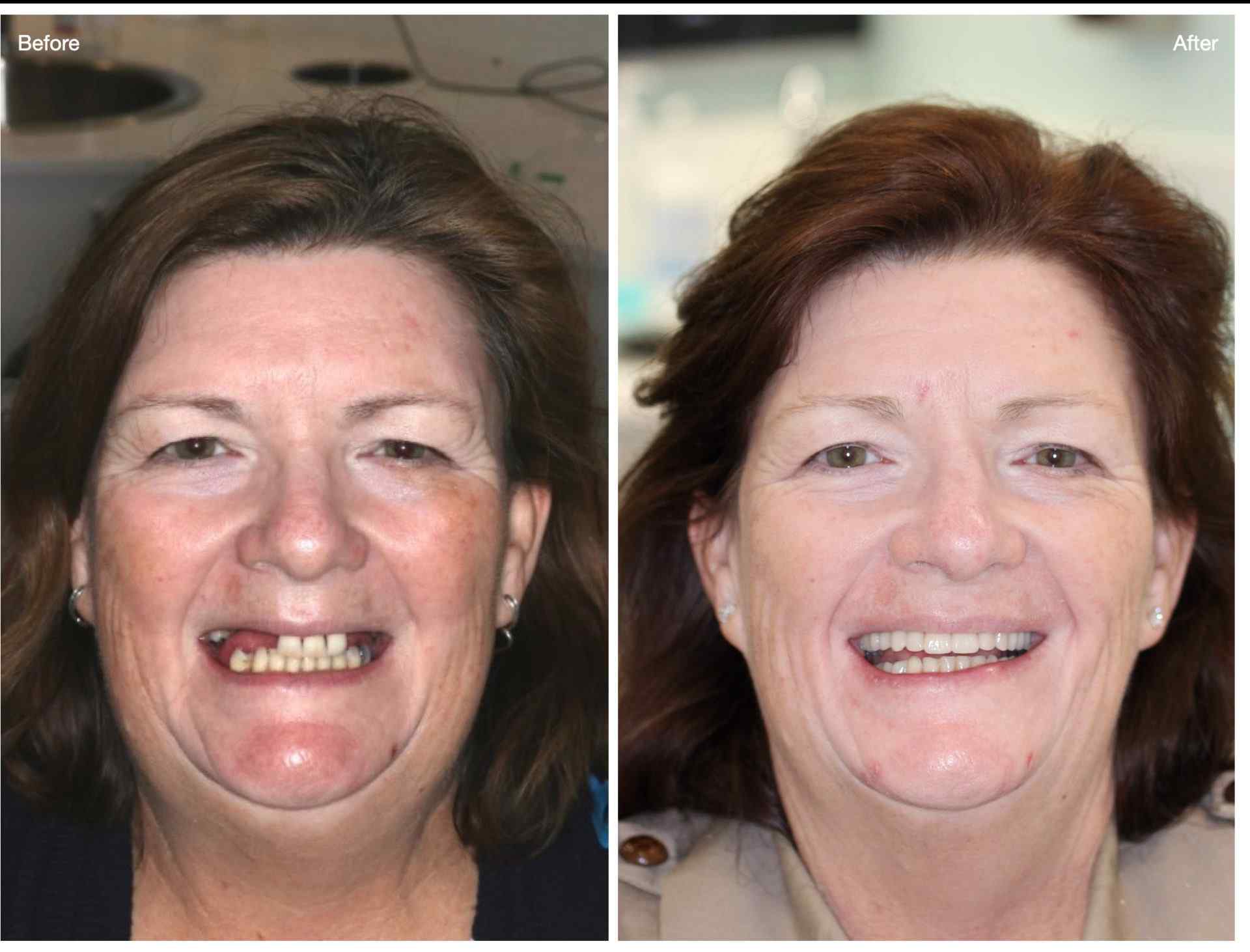 Confidence back with implant dentures