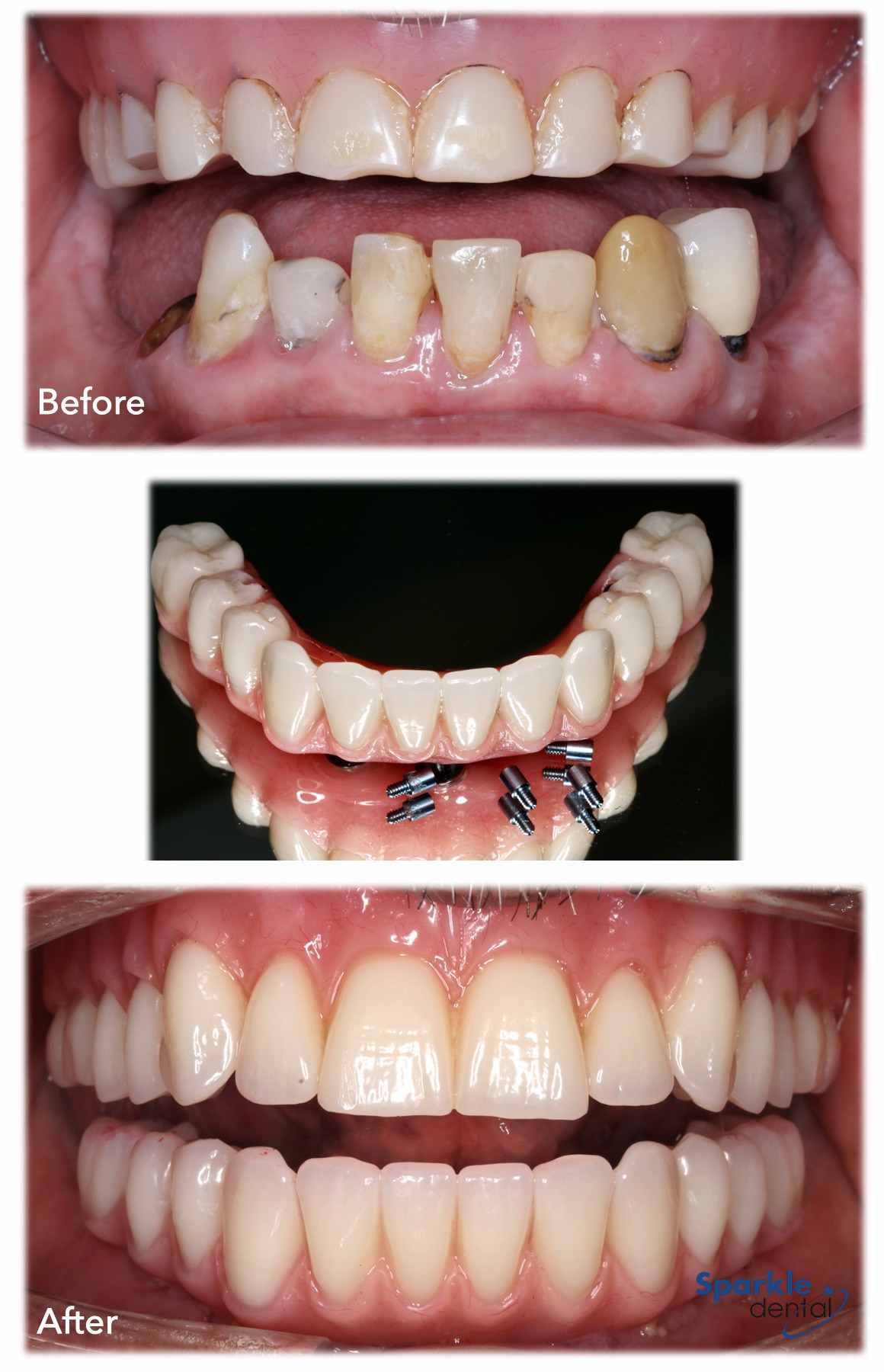 Before & after dental implant treatment