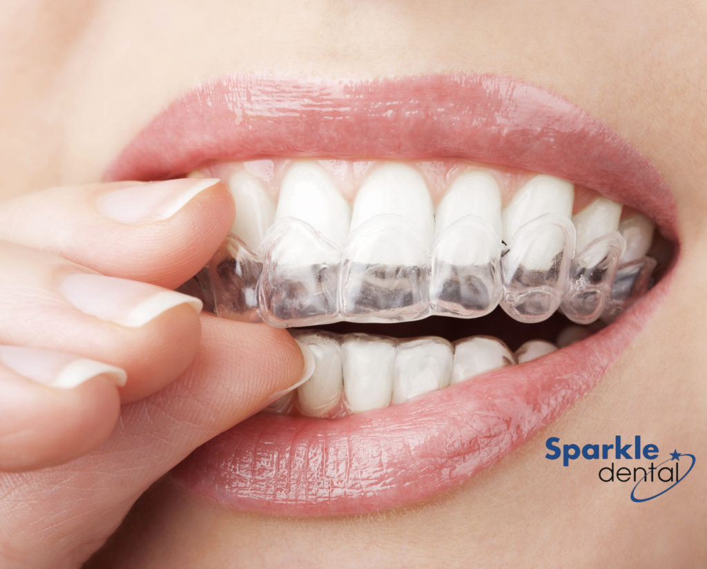 Invisalign For Adults