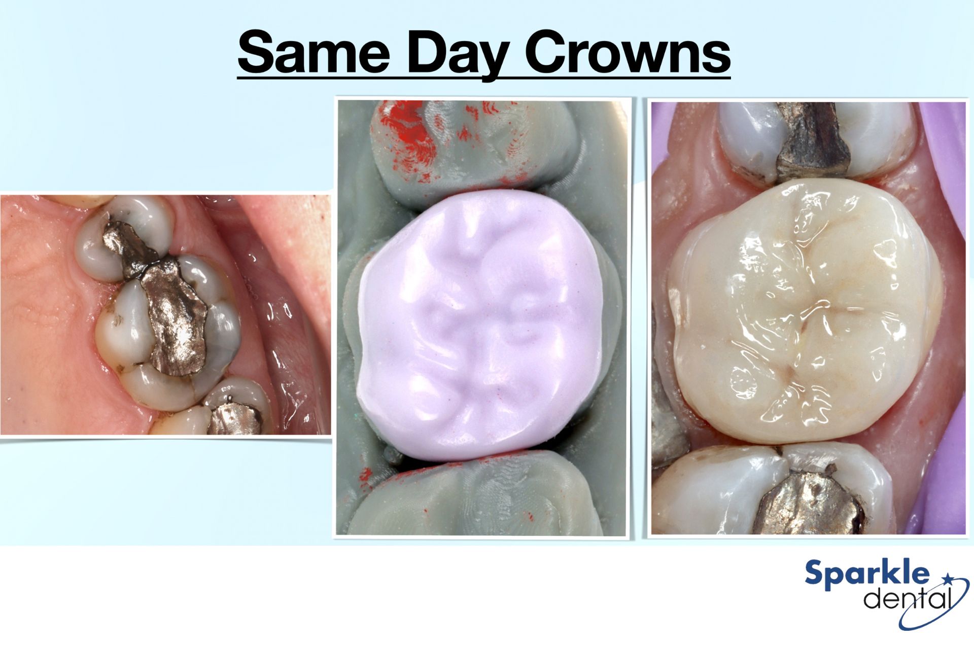 Same Day Crowns