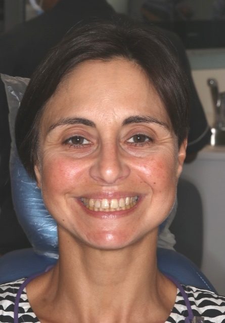 Before smile makeover treatment