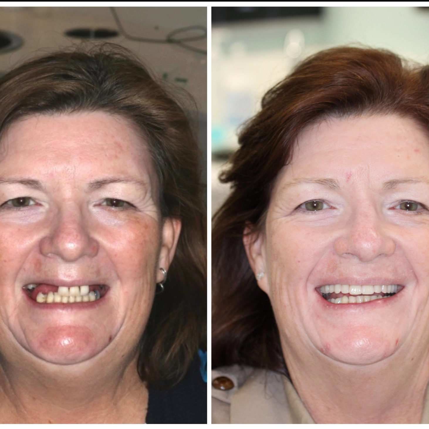 Confidence back with implant dentures